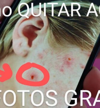 quitar acné de fotografías.